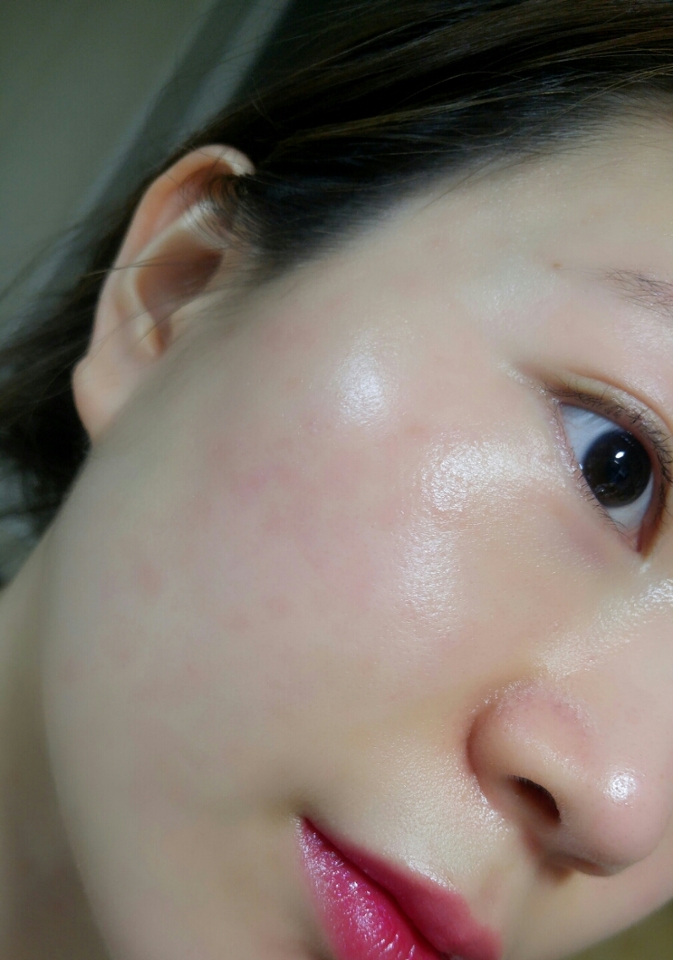 바르기 전 피부에요
마침 요며칠 피부가 심각하게 뒤집어져가지구ㅠㅠ 요즘 계속 피부과 다녔는데 다녔는데!! 아직 안나았는데!!!!!
의도치 않은 커버력 테스트네요ㄱㅋㅋㅋㅋㅋ