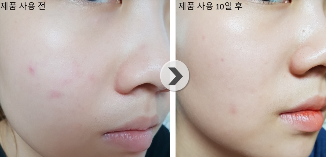 평소에 에센스를 사용하지않아서 효과에 대해 큰 기대를 하지않았는데 제품받고나서 쭉 써본 결과 여드름 흉터를 제외하고 트러블과 좁살 여드름이 모두 사라졌어요! 
다른 영향도 받았을 수 있지만 이 제품의 영향을 받은건 확실한 것 같아요!