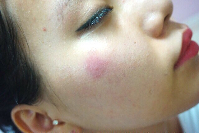 세안하고오니 알레르기성 두드러기가 있어서 
모기물린 것 처럼 저렇게 올라와 있어요 ㅠㅠ