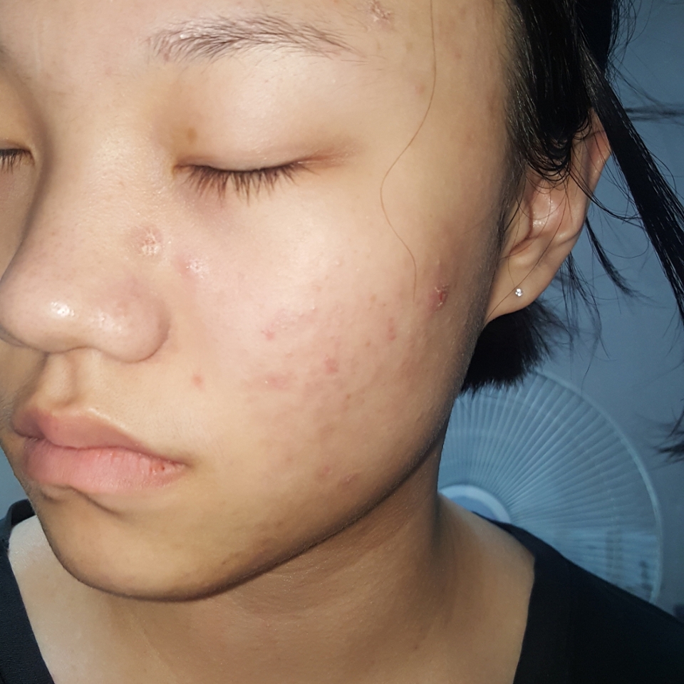 사실 화장하면 화장독 올라서 하면 안되지만 오히려 해줘도 조금 괜찮아지길래 저는 화장을 가끔씩 해요!! 빨리 낫고 트러블없이 화장하고싶네요... 트러블 없었던 때가 언젠지 기억도 안난다죠ㅎㅎㅎㅎㅎ