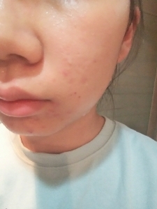 세안 후
진짜 깨끗하게 꼼꼼히 클렌징 된 느낌이라 개운했어요💙 하지만 클렌징이 잘된만큼 피부가 건조하니 보습 잘해주는 거 잊지 마시구요! 갠적으로 피부에 무리가 안 가는 천연 제품이라 너무너무너무 좋았답니다♥(냄새만 빼면..)