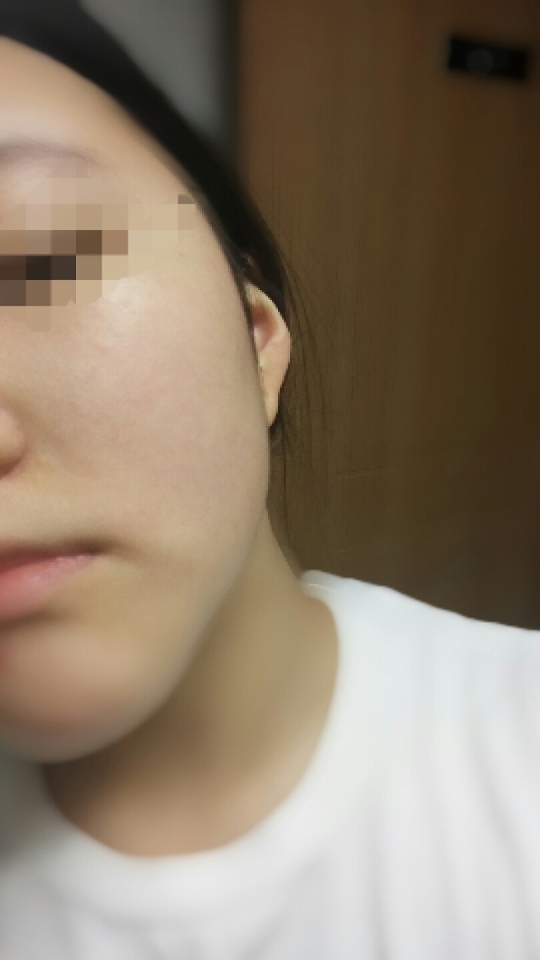 세안 후 아무것도 바르지 않은 상태 입니다! 하.하.하 피부에 홍조가 많네요ㅠㅜ