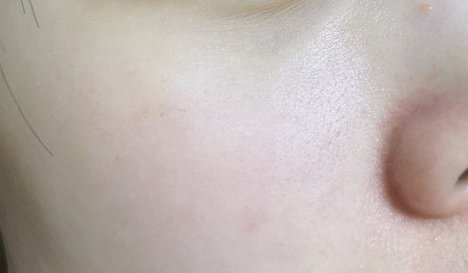 아무것도 안 바른 피부에요. 세수 직후 건조건조한 피부,,, 아 참고로 이 수분 크림에는 향료 빼고 별다른 위험 성분이 없는데 저는 그냥 되게 잘맞았어요 순하고 트러블 없고!