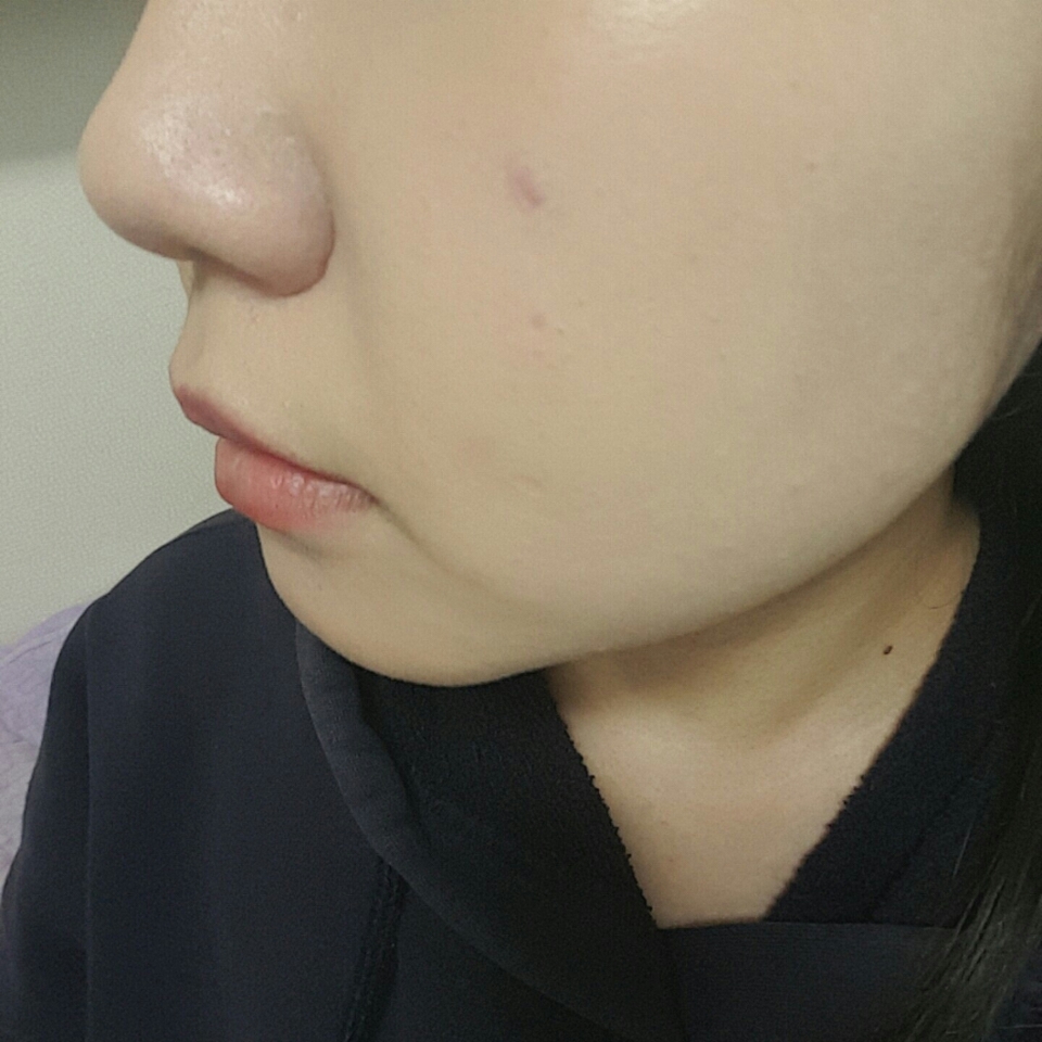 바른쪽입니다
안바른쪽과 확연히 차이가나죠? 자잘한트러블이나 피부톤정리는 확실히 되는것같아요!