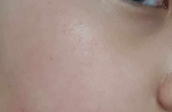 전) 피부가 붉은 부분이 있고 살짝살짝 트러블이 난 상태예요
