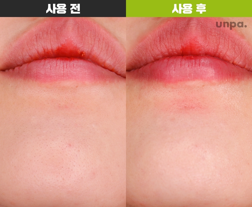 블랙헤드 브러시는 턱과 미간에 사용해봤어

턱에는 생긴지 얼마 되지 않은
작고 귀여운 블랙헤드가 많은데,
브러시로 모공 사이를 클렌징 해줘서 그런지
꽤 깔끔해졌더라구