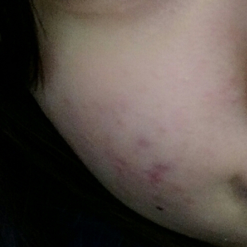 이게 쌩얼인데 정말 울긋불긋..왕드름이 왕창 있죠 ㅜㅜ