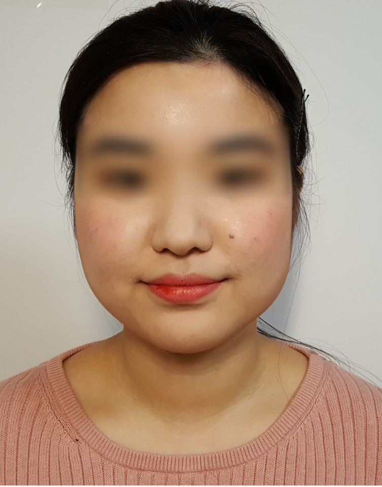 그럼 매끈 여리여리 복숭아 피부 완성!!!

*트러블피부는 커버 뿐만아니라 관리가 중요하신것 아시죠?
예쁘게 메이크업 하고 모공까지 깨끗히 클렌징해주시는것 이가장 중요하답니다~♡♡
다들 잘보셨나요~? 도움이 많이 되셨으면좋겠네용 ㅎㅎ 
그럼 2018년 더더 예쁘지시고,
끝까지 제 컨텐츠 봐주셔서 감사합니다~☆
앞으로 유용한 컨텐츠와 꿀팁으로 자주 오겠습니다~안녕~!!:)


