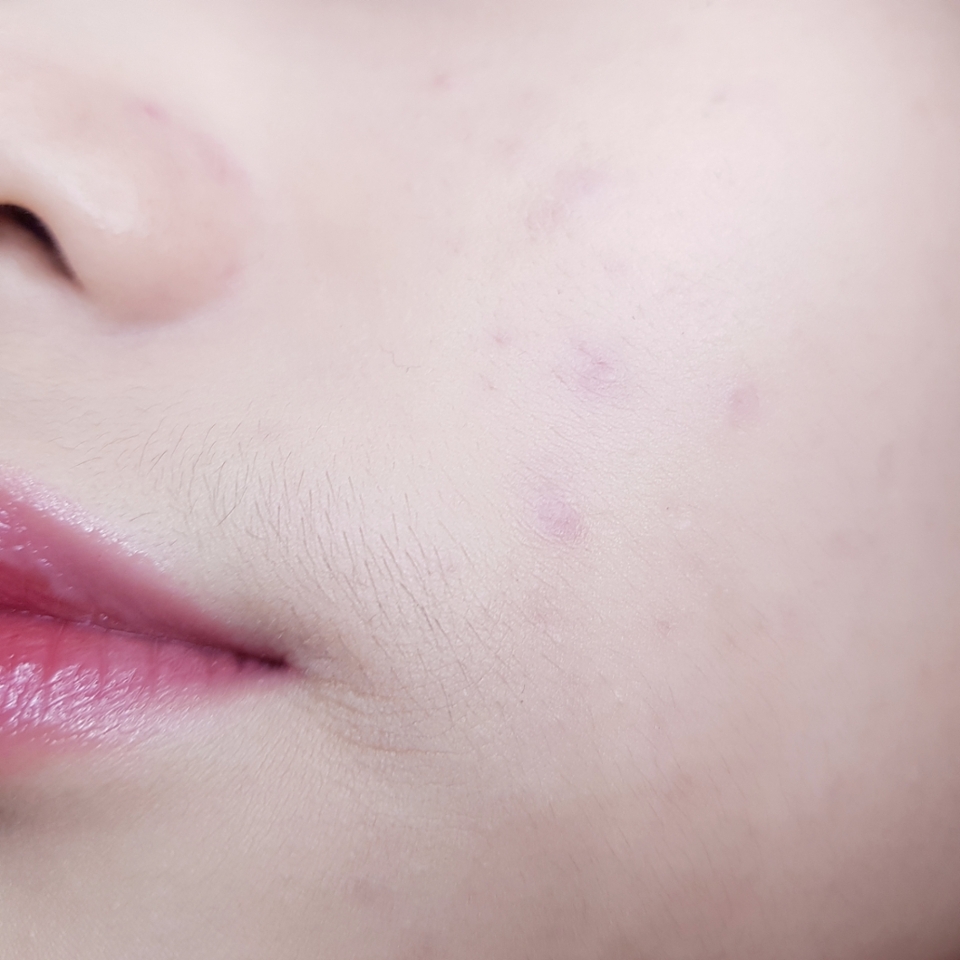 비벨벳 커버 쿠션 사용 후 모습이에요.
​
저 진짜 쿠션 두드린 후에 제 모습 보는데 깜짝 놀랐어요...
이렇게 심각한 상태의 피부를 깔끔하게 커버해준게 신기하고 놀랍더라고요.
컨실러 사용 1도 안 했는데도 이 정도....
​
심지어 제가 일부러 양을 최대한 많이 안 묻히려고 노력해서, 소량으로만 바른 상태에요!
붉은끼와 얼룩덜룩한 착색들도 잘 커버해줬는데 무엇보다 두꺼워 보이는 피부표현이 아니라서 더 맘에 들었어요!
보통 커버력이 우수한 쿠션은 피부표현이 두꺼워 보여져서 쉽게 답답해 보이는데 비벨벳 쿠션은 그런 느낌 전혀 없이 깔끔하면서도 자연스럽게 커버가 돼서 마음에 쏙 들었던 쿠션이었어요!
​
또 매트한 제형이라서 모공 커버에도 딱 좋더라고요.
따로 프라이머를 사용 안 했음에도 깔끔하게 커버가 돼서 베이스 메이크업 단계를 축소화 시키는데 도움을 줄 것 같아요 ㅎㅎ
​
물론 입가 주름에 제대로 밀착이 되지는 않아서 조금 애매해보이는데
이거는 제가 사실 입가 부분에 집중적으로 두드릴 생각을 못 하고 대충 찍어 발라서에요...
팔자주름이나 눈가 등에는 끼임 없이 깔끔하게 밀착이 돼서 주름 부각이 없었어요!
​

