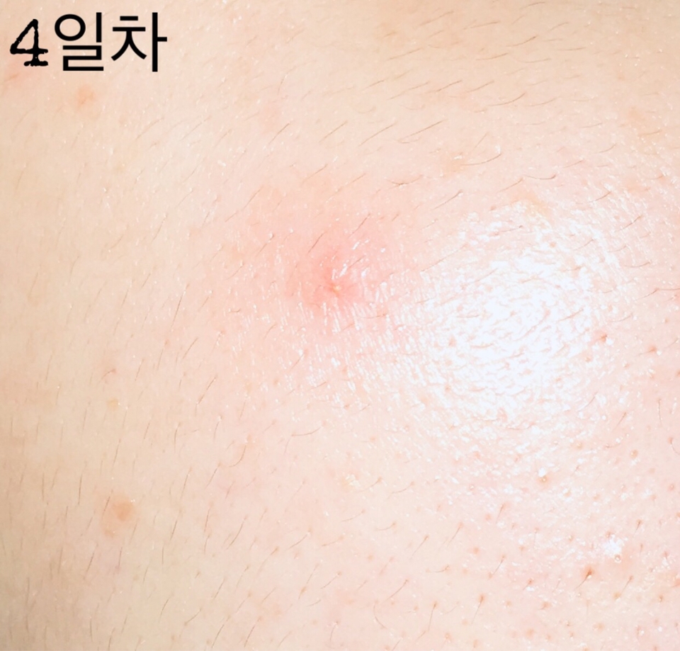 4일차에는 상처가 회복되면서 표피가 형성되고 많이 가라앉는걸 확인할 수 있었어요 

사용중인 스킨케어, 메이크업 성분이 100% 안전하지도 않고 트러블 부위에는 스킨케어 바르기가 조금 찝찝한데 스팟 패치로 상처를 보호할 수 있어서 참 좋더라구요

위생적으로 안전하게 케어할 수 있어서 패치 붙이지 않았을때 보다 진정 속도가 조금 더 빠른거 같아요