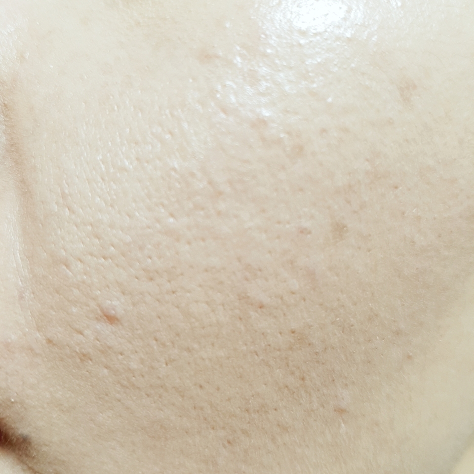 커버력은 중!
그리 진한 잡티는 아니었는데
눈부신커버의 면모는 볼수가 없었어요.
부분적으로 덧발라 주었는데도
크게 안가려지더라구요.
좀 옅은 정도.^^ 
그래서 가렸다고 보기엔 좀 무리인듯 싶어요.
