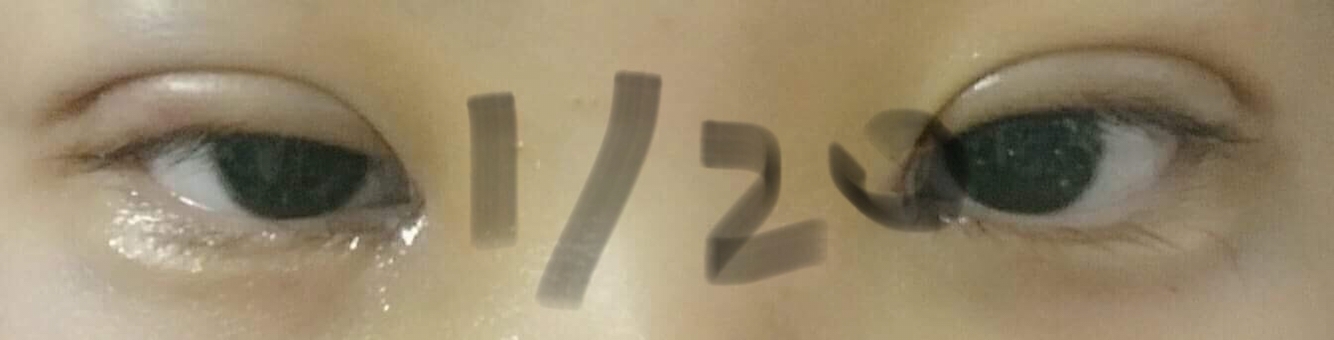 눈앞에있는 흰 눈꼽 ...^^ 처음엔 약인줄알고 그대로 냅두고 살다가 면봉으로 살짝만 건들여서 떼도 잘떨어져요 굳이 비빌필요가 없었습니다 최대한 수술부위에 닿지않게 조심히 했습니당