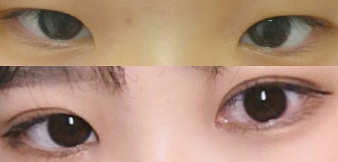 대망의 쌍수 전후 
가장 최근 눈이에요 ㅎㅎ
쌍수전은 쌍액하지 않은 눈이구요 !