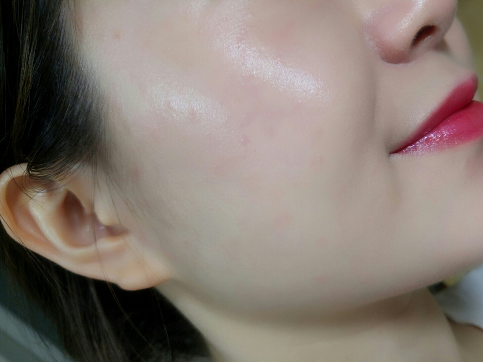 저 선크림이나 메이크업베이스 이런거 하나도 안바르고 바로 발라본건데 광도 예쁘게 올라오고 커버력도 좋아서 전체적으로 피부가 깨끗해보여요😃

모공을 가려주지는 않는데 모공부각이나 끼임은 없었어요!
광이 도는 제형인데도 빛받을때 모공부각 없었어요👍
