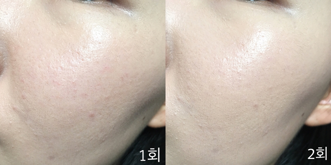 제품 설명에 덧바를수록 화사하고 윤기있는 피부로 연출된다고했는데, 그 설명이 딱 맞더라구요!


잡티가 많은 부분에만 한 번 더 발라주었는데, 커버력도 더 높아지고, 피부가 더 화사해졌어요! 


게다가 광도 더 뿜뿜해서 저어어어어어엉말 안좋았던 제 피부를 건강해보이게 만들어주더라구요👍