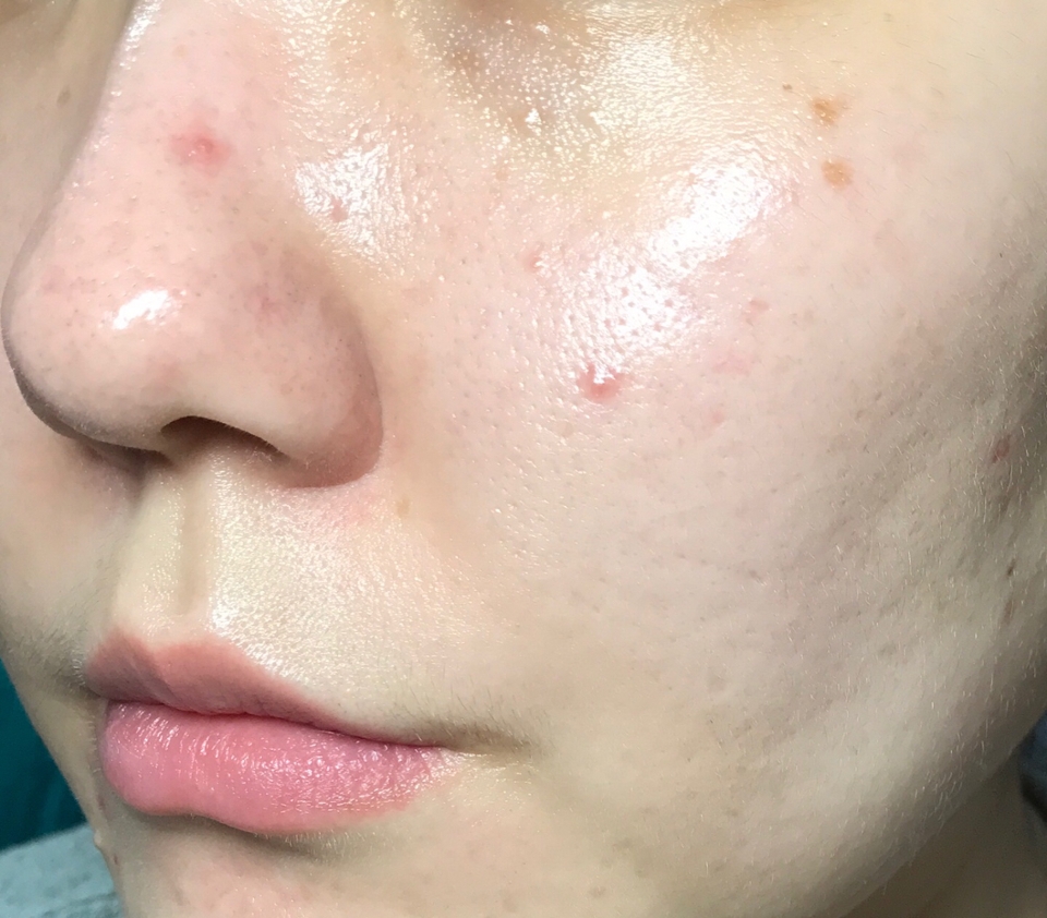 사용하고 나니 얼굴이 급격하게 밝아지더라구요!!

그리고 피부의 붉은 기운도 가라앉구요 ㅎㅎㅎㅎ