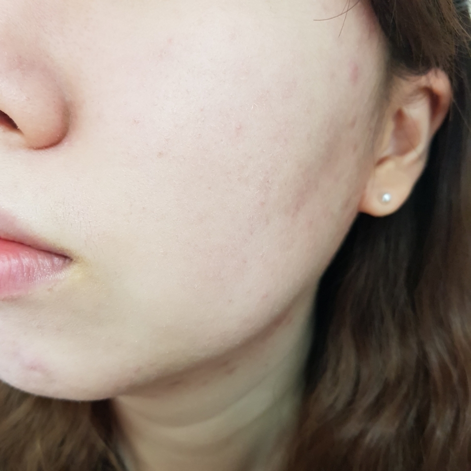 쿠션을 바른 모습입니다. 저는 여기서 제일 놀란게 코 옆쪽에 끼임없이 깔끔한게 발린 점이에요!!! 타 쿠션이나 파데를 바를때 항상 코 옆쪽이 깔끔히 안발리거나 들뜨곤 했었는데 이 쿠션은 저어언혀 그런거 없이 예쁘게 발렸습니다. 또 사진을 보면 아시다시피 보송하게 마무리 된 걸 볼 수 있는데 파우더처리를 전혀 하지 않았다는점!! 그냥 이 쿠션의 마무리가 저렇게 보송하게 되는 거에요!!! 저는 지성이라 조금이라도 광나는걸 싫어해서 세미매트한 타입의 제품을 사용할 때도 파우더처리는 필수로 하는 편인데 이 제품은 따로 안해도 보송하게 마무리가 되었어요 저는 여기서 한번 반했습니다ㅎㅎ ❛˓◞˂̵✧

다만 아쉬웠던게 촉촉하게 발리긴 했지만 다른 쿠션에 비해 잘 펴발리지는 않았고, 커버력이 우수한 편은 아니였어요.. 사진에서는 커버가 잘 된것처럼 보이지만 직접 눈으로 보았을때는 붉은기가 잘 가려지지 않았어욤,,