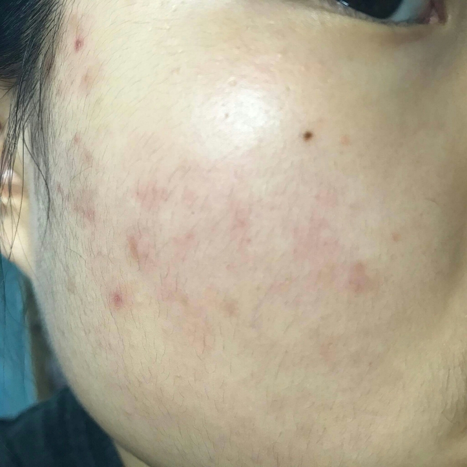 드디어 !! 제 여드름을 가려볼게요 ... 붉고 어두운 여드름ㅠㅜㅜㅜㅠㅠ언제 없어질까요?