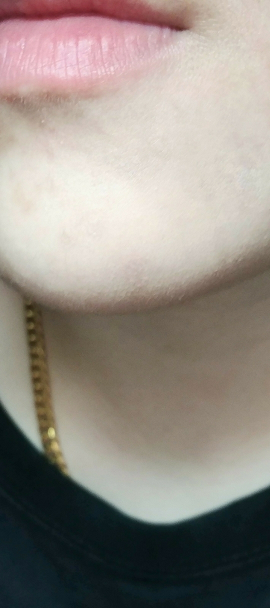 그날로 인해 올라온 턱의 흔적입니다ㅠㅜ

바르기 전 후 사진이에요

커버력은 정말 좋아요 밀착력도 있고 지속력도 좋은 편이구요 하지만 두껍게 발리면서 이 컨실러가 성분 때문에 트러블이 난다 하시는 분들이 많으시더라구요

커버력★★★★*
지속력★★★★*
밀착력★★★★
성분★★*
발림성★★★*
발림성은 너무 묽지 않고 적당하지만 꽤 두껍게 발려요!
색상★★★★
색상이 전체적으로 맑다기 보단 탁하다 싶은데 컨실러는 어느 정도 회빛이 돌아야 붉은 트러블 가리기 좋다 생각해서 색상자체는 맘에 들어요!
다크닝★★★★★
금방 다크닝이 오고 다크닝이 오면 색상 전 후 차이가 심하니 고려해서 구매해주세요!