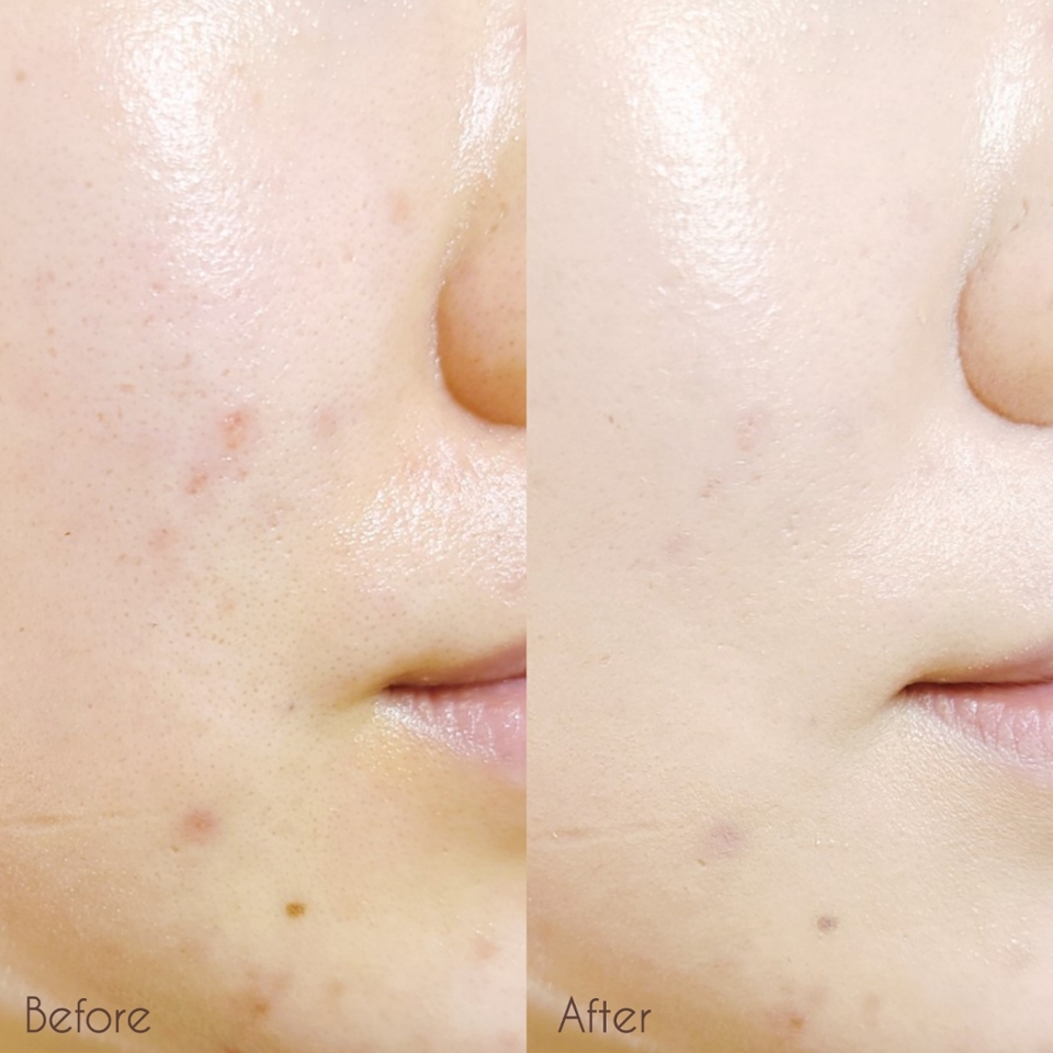 답답하게 모공 막는 느낌 없이 담백한 커버라 한층 순한 느낌😊

​

트러블 뿐만 아니라 피부 요철까지 깔끔하게 커버할 수 있어요

​

매트한 커버 팩트는 자연스러운 피부결을 살리지 못하고, 글로우 팩트는 트러블성 피부가 쓰기에 커버력이 부족했다면, 에이솔루션 아크네커버팩트는 커버력과 촉촉함을 동시에 챙긴 중간 정도의 제품이 아닐까 싶어요

