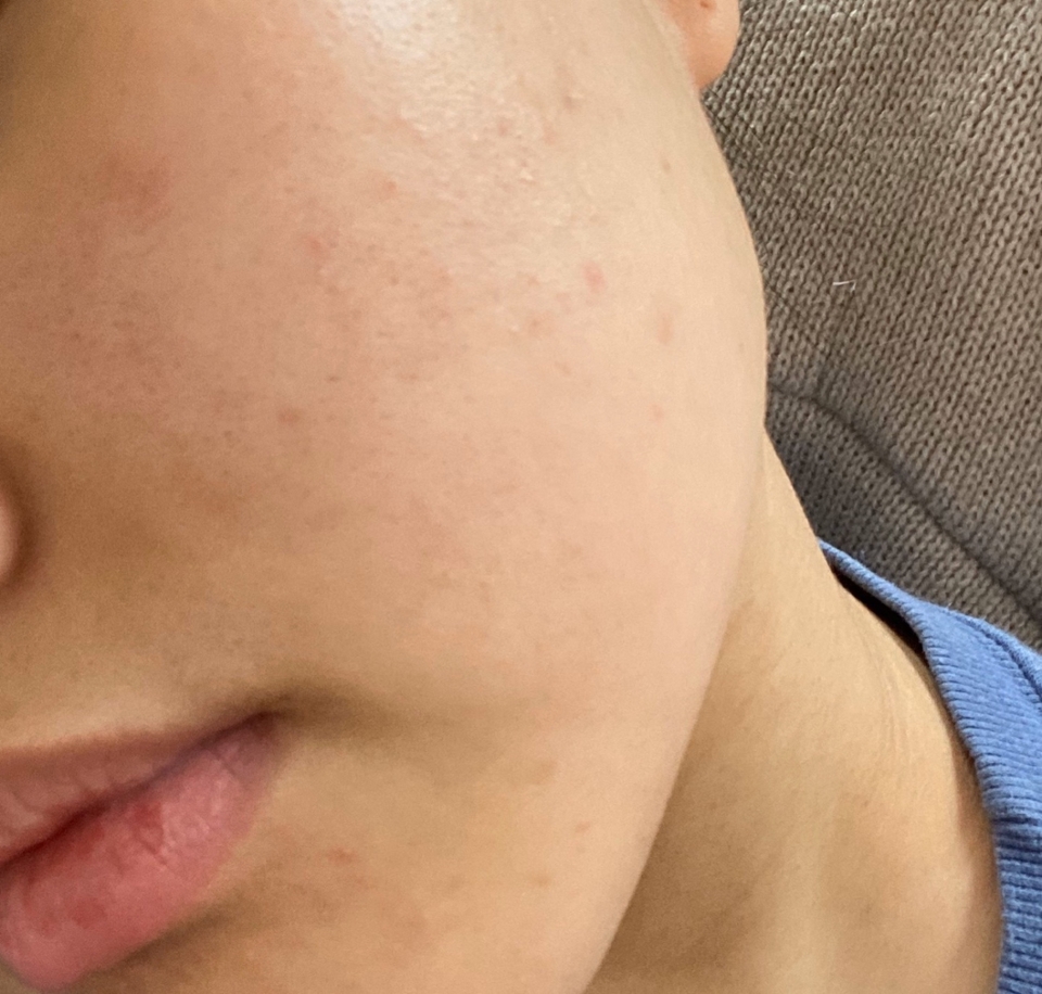 ㅋ 빠꾸없는 내 얼굴 요새 마스크랑 전쟁중인 제 피부에요 ... 다들 코로나 조심하세요 마스크도 꼭 끼시구 !!! 다들 무시하고 꽃놀이가던데 우리 꽃놀이는 내년에 갈 수 있으니까 서로 조금만 배려해요 ෆ 어쨌든 저는 모낭염 피부를 가지고 있고 볼쪽에 여드름흉터가 많은 편입니당 ㅠ