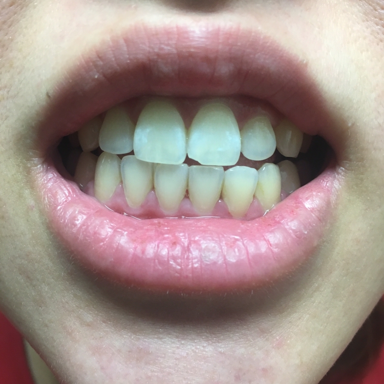 ㅋㅋㅋㅋ 못난 치아 계속 보여드려서 죄송해요
양치하고 나니 개운하네요 ㅋㅋ
아직 사용한지 일주일 정도 밖에 안되서
확연히 하얘졌다고 장담할 순 없지만
느낌으로는 좀 환해진 느낌!!??
이시림이 없어서 너무 좋네요
조금 더 써보고 효과가 좀 더 보이면 지속적으로 구매할 생각이에요
저보다 이가 누런 친구에게도 선물할까 고민중...


이상 뷰센H 치약 리뷰였습니당 !!