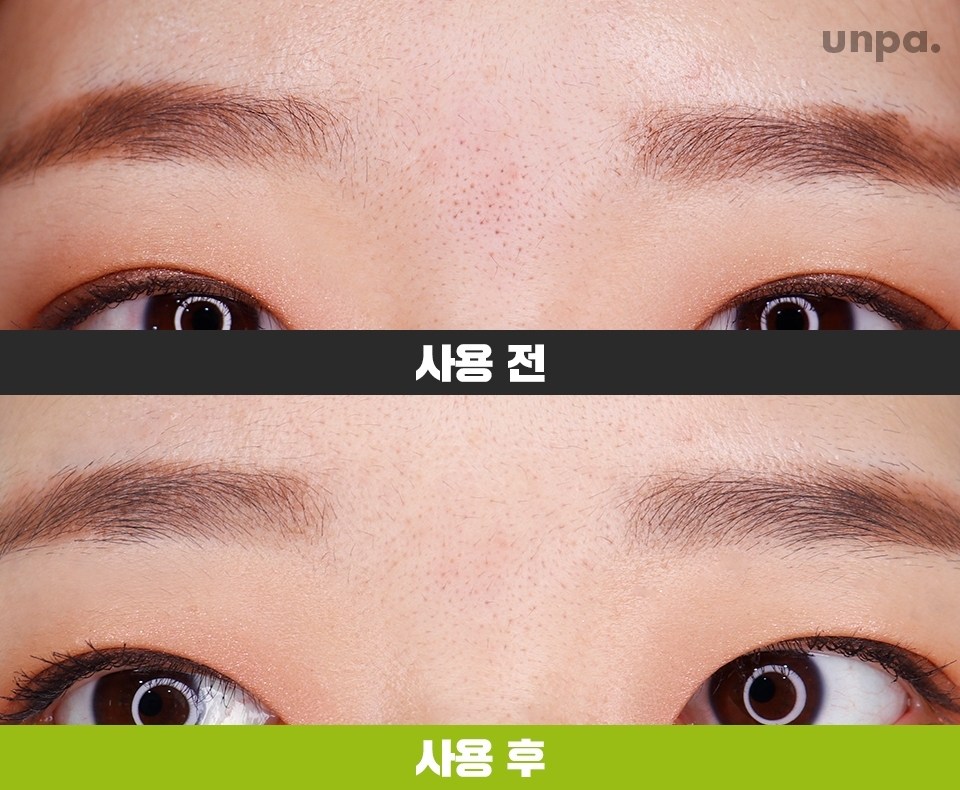 턱에 비해 모공이 넓고
뿌리 깊은 블랙헤드가 많은 미간에는
눈에 띄는 효과 없었움...