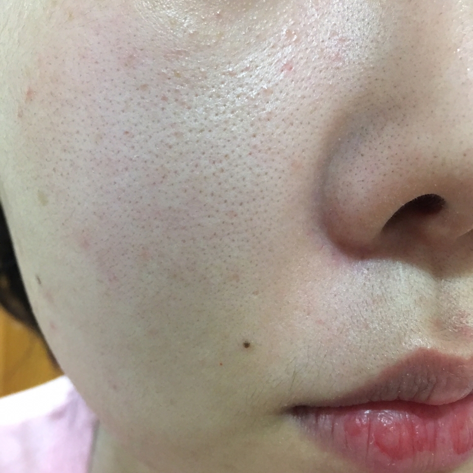 이게 바로 비포 사진입니다 
사용 전 세안 후 토너로 정돈해주고 후다닥 찍어봤어요 
모공케어 안한지 오래되서 그런지 모공이 아주 돌하르방 수준이네요😭😭😭
⚠️비포, 에프터 사진 모두 보정 1도 안했습니다 