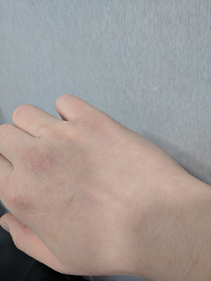 토너패드 쓰임새는 여러가지지만 일단 보습효과는 어떤지!! 제 건조 건조한 손에 실험해보았어요. 손가락 사이사이 부르튼거 보이시나요... 하루에 서너번씩 핸드크림 발라도 저렇답니다 엉엉😭