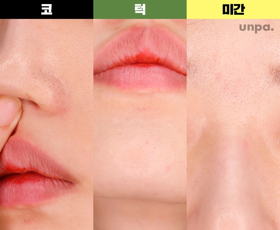 블랙헤드 집단 거주 지역 코!
앞머리 덕분에 이렇게나 많이 생긴 줄
꿈에도 몰랐던 미간,
그리고 은근 신경 쓰이는 턱까지!

블랙헤드가 신경 쓰이는 부위에
각의 제품을 일주일 동안 사용해보고
후기를 알려줄게