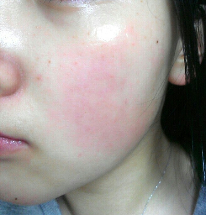 팩 사용 후❤
와...완전 춱춱하고 피부가 쫀쫀해져요!
다른 팩들에 비해 끈적하지만 그만큼 보습되니까 괜찮아요ㅎㅎ