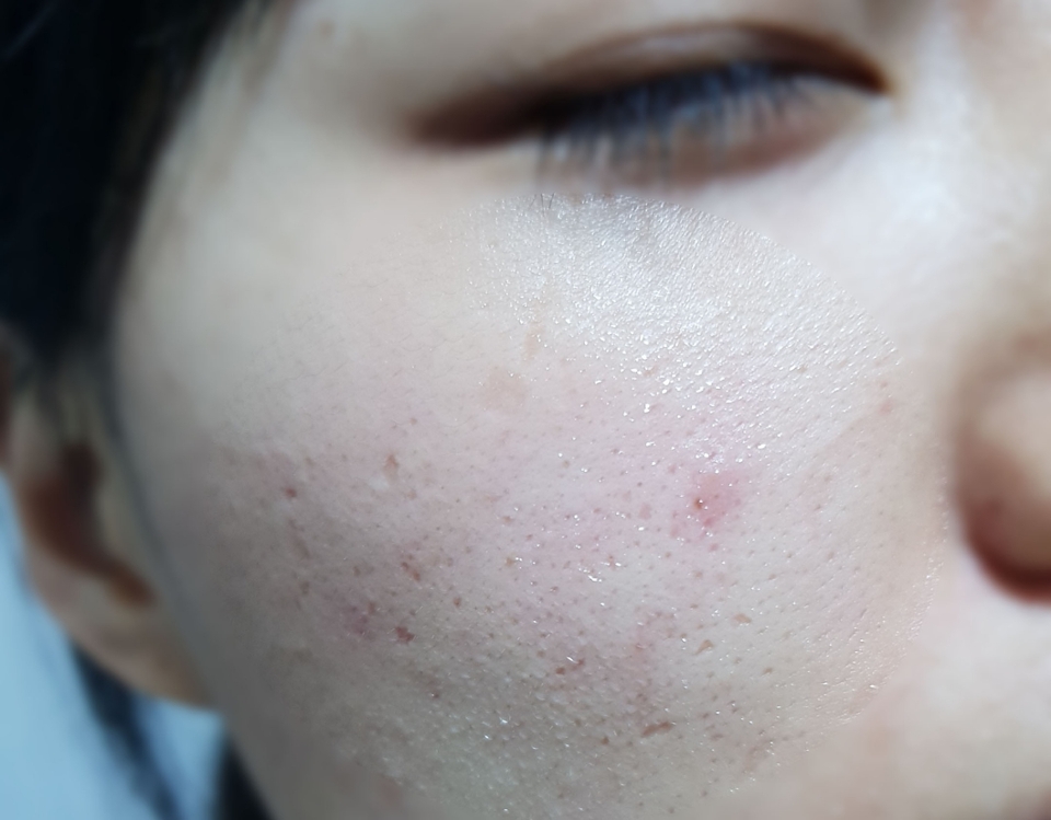 
화장솜에 적신 독도토너가 피부에 굉장히 잘 맞네요.
초초민감성을 위한 제품이라서 그런지 눈에 들어가도 안아프고, 피부도 한결 가볍게 마무리되더라고요.