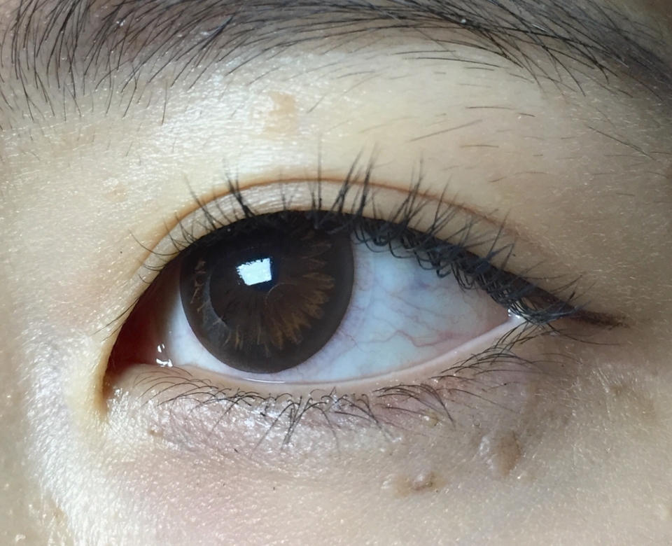 하루 10시간이상 렌즈끼는 최악 건조안인 저는 충혈이 있어요 ,,

아큐브는 눈물순환이 잘 안되지만 눈에 딱 안착되어 이물감이 느껴지지 않는 구조에요