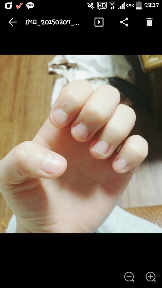 고쳐야겠다고 생각하고 하루 참은 후에 찍은 사진이에요.
ㅋㅋㅋ지금보니 진짜 제 기억 속의 모습보다 더 심하네요ㅠㅠㅠ