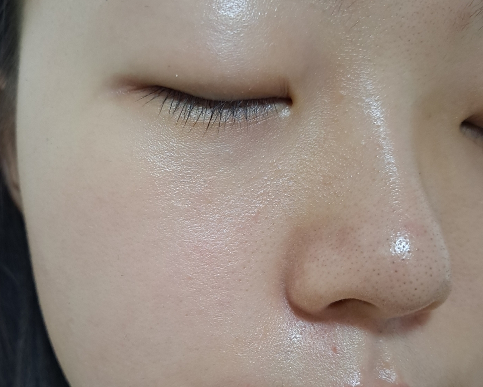 비포