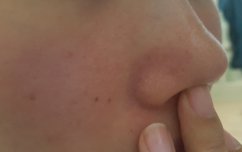 극혐주의🤢
모공관리 하기전에는 요로케 피지들이 너도 나도 할 거 업이 빼꼼ㅠㅠ
지지하네여 이제그만 헤어져야 할 시간 🖐