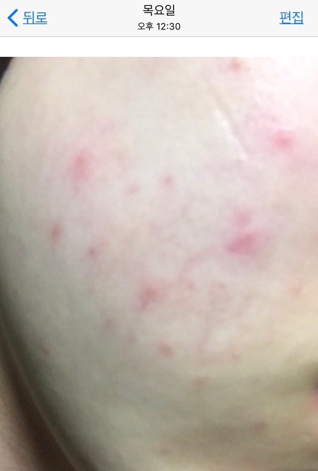 목요일 제 피부인뎅 병원도 갔다왔는데..하..
3/17(일요일)부터 이 상태였습니다💧
사진으로 보이지 않지만 턱라인을 따라 좁쌀도 있었어요 진짜 절망적인;

접촉성 피부염 + 미세먼지😥