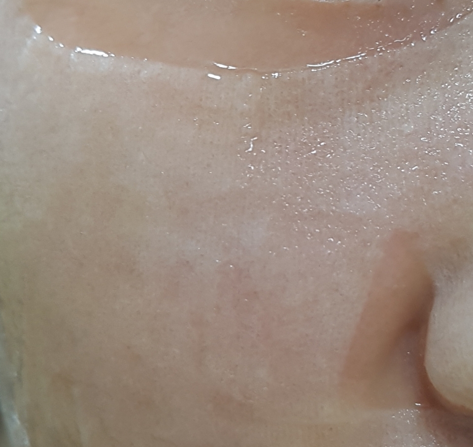 바로 얼굴에 붙이면 이렇게 얇은 재질의 마스크 팩이 피부에 촤아아악 ! 밀착돼요. 

시트 자체가 순면이라서 정말 자극적이거나 떼어질것 같다는 느낌 1도 안들어요 ㅎㅎ 

더군다나 엄청 얇고 밀착력도 좋아서 떨어지거나 그러지 않아요. 

제 모공이 보일정도면 얇은게 보이시죠 ..? 거의 투명한 느낌이랍니당 ㅎㅎ

약간 특이했던 점, 이게 레몬 추출이라서 그런지  에센스 자체가 노란 빛을 띄더라구요 !! 옛날에 먹던 레모나 레몬맛 색 ..?! 그런 색이였어요 ㅋㅋㅋㅋㅋㅋㅋㅋㅋ  



근데 여기서 진짜 봐야되는건 여러분 .. 에센스 진짜 흘러 넘쳐요 ㅠㅠㅠㅠㅠㅠ 뚝뚝 떨어질 정도로 진짜 흘러 넘칩니다.🤩 

전 처음에 한번 뚝 떨어지고 그 뒤로는 한번도 안떨어졌어요 ㅎㅎ 피부에 잘 흡수 되더라구용 