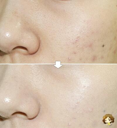 피부톤 균일화와 거뭇거뭇, 울긋불긋한 여드름 흔적과 홍조에서도
균일하게 커버가 되고, 여드름에도 심한 자극 없이 깔끔하면서도 보송보송한 베이스메이크업이 가능