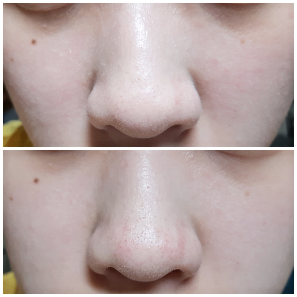 아랫사진이 사용 후인데 코 모공들이 깔끔해졌어요! 확실히 블랙헤드랑 화이트헤드를 정리해준 것 같아요~ 또 미세먼지까지 씻어준다니 굿굿