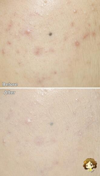 보송보송한 마무리감의 탓일까요, 벤조일 연고 바르는 중인 유스루의
트러블들에는 희여멀건하게 피부밀림현상이 부각되고, 좁쌀 여드름 부각