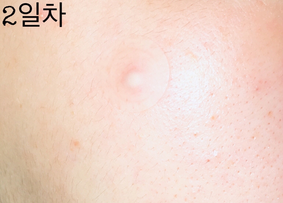 다음날 일어나서 확인해보니 트러블 주위에 빨갛게 부풀었던게 가라 앉았지만 삼출액에 의해 상처 부위가 하얗게 부풀어 올랐어요