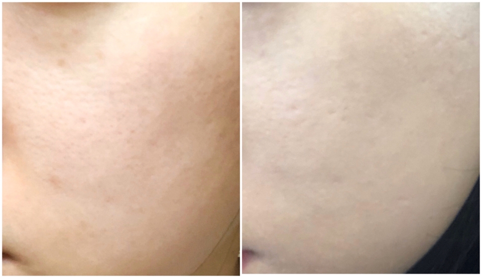 화장 전 ----후모공과 흉터가 있는 피부라 너무 건조한 베이스 메이크업 제품은 잘 사용하지 않는 편이에요!확실한 모공끼임을 확인해 보려고 프라이머 없이 단독으로 발라 보았는데, 보.이.시.나.요?들뜨거나 끼임 없이 촉촉하게 발렸습니다!! 모공부각도 없었어요 확실히 척톡한 편이라 은은하게 광도 돌고 괜찮았습니다!!