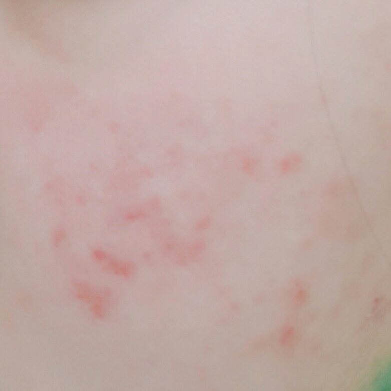 불긋불긋한 제피부입니다...ㅠ