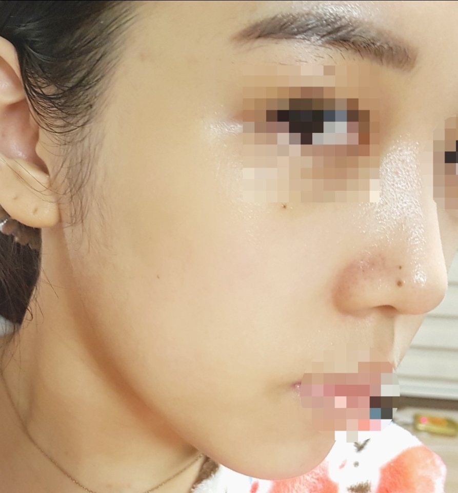 팩을 떼고 앰플까진 바른 모습인데
하이드로 베타는 앰플이 정말정말 촉촉해요~
바르고 나면 피부속까지 수분이 꽉차는 느낌? ㅎㅎ

클리어 알파는 살짝 촉촉함은 덜하고 끈적여요!
바를땐 부드럽게 발리는데
흡수되면서 끈적임이 있더라구요~

그리고 마지막으로 라이트감마는
살짝 촉촉하면서 피부가 화사해져요!
그 화사함이 계속가는 건 아니지만
팩하고 앰플까지 하고나면 확실히 전보단
화사해보이더라구요 ㅎㅎ😄

저녁에 이 팩하고 자면 
다음날 화장이 너무 잘먹고 뜨지 않아서
저같은 경우 평소에도 꾸준히 하지만
중요한 날 전 날같은 경우는 꼭꼭 해주고 있어요!

올리브영 팩 세일은 자주하니까
세일할 때 노려서 꼭꼭 사용해보세요 :)
강추 ~! 👍👍