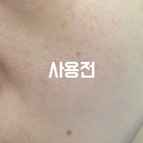 사용전.... 사진 화질이 좀 그래서 잘 티가 안나는데 건조하고 홍조 있는 피부였어요ㅠㅠ건성 ㅜㅜ하아