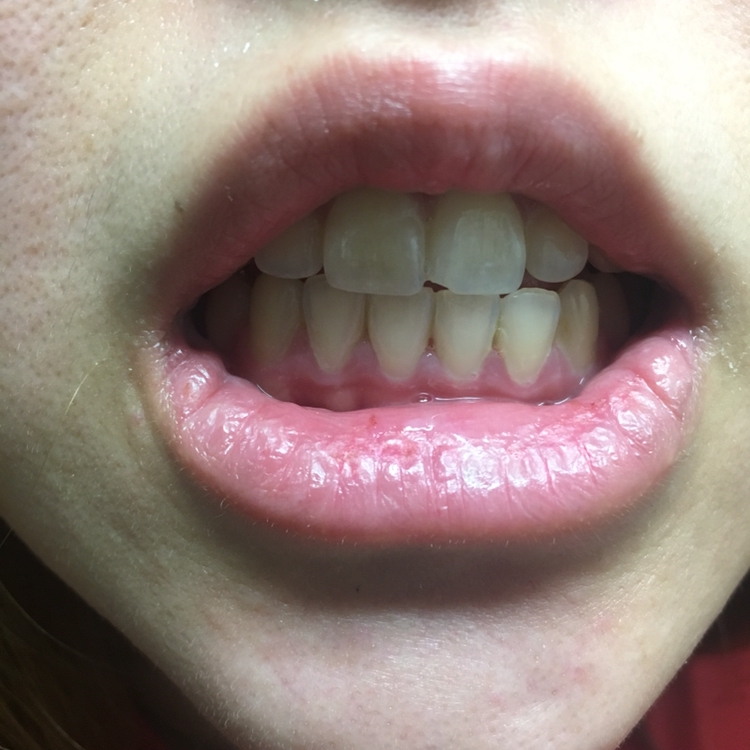 더러운 치아 죄송합니다..
아침에 일어나서 치아에 플라그가 그득그득 낀 상태에요
치아도 약간 노랗게 착색된거 보이시죠..