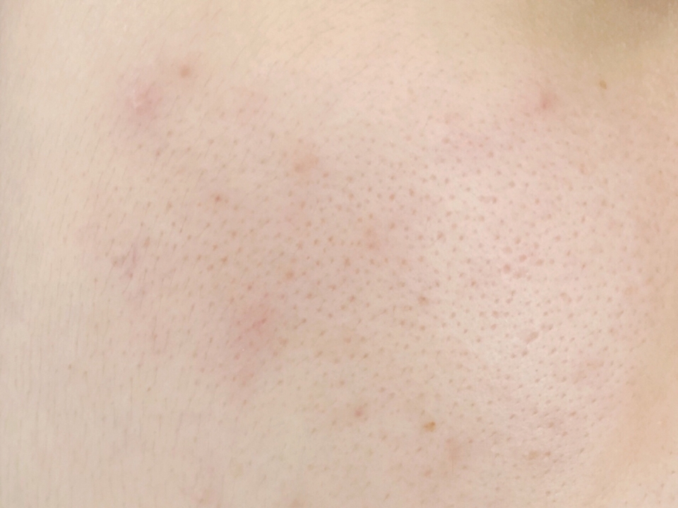 이제 제 피부에 얹어볼게요! 음.. 제 생얼입니다... ㅠㅠ 

볼 부위인데, 저는 여드름(트러블) + 수부지 피부입니다. 붉은기와 넓은 모공, 잡티 때문에 프라이머와 커버력 좋은 쿠션은 필수에요 ㅠㅠㅠ 😢