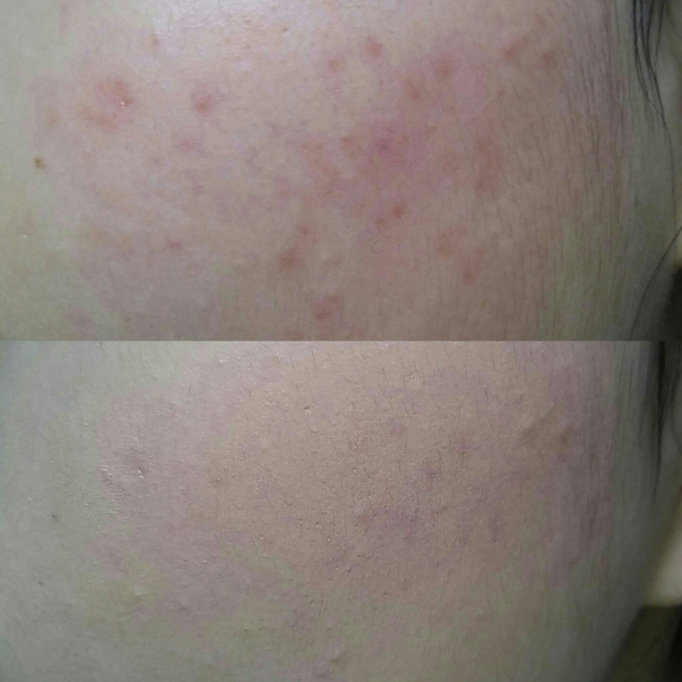 볼커버 사진이예요~ 붤씬 자연스럽게 발린게 보이시죠? 그래도 사진찍고 조금 중요한 날에는 이 컨실러에 자연스럽게 손이 가는 것 가타용...ㅋ 이 사진도 실제랑 너무 다르게 나왔네요..ㅠ



제 리뷰가 유용하셨다면
좋아요💓 팔로우💓 부탁드립니당💓